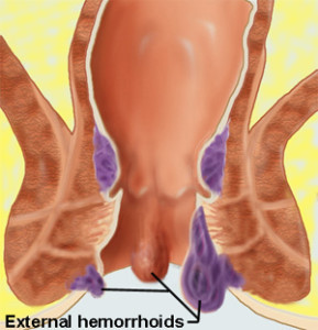 Hemoroid extern